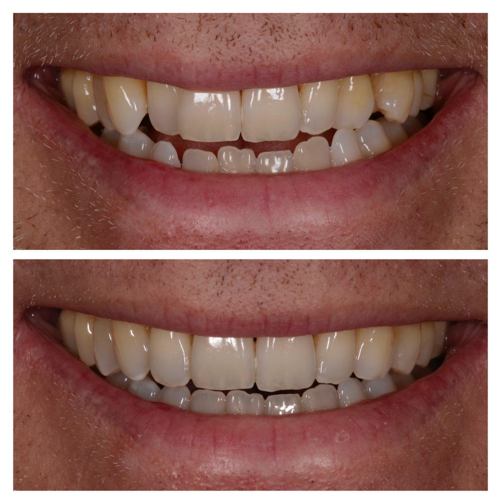 Behandelingen Nieuw_Orthodontie Bram Smile-31