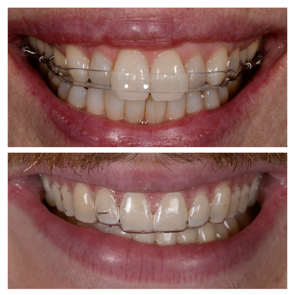 Behandelingen Nieuw_Orthodontie Bram Smile-32