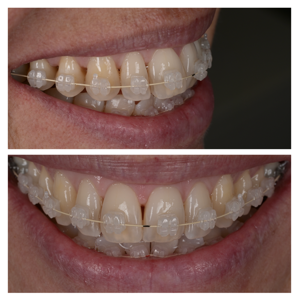 Behandelingen Nieuw_Orthodontie Bram Smile-33